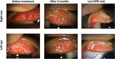 Incremental Concentrations of Tacrolimus Eye Drops as a Strategy for the Management of Severe Vernal Keratoconjunctivitis